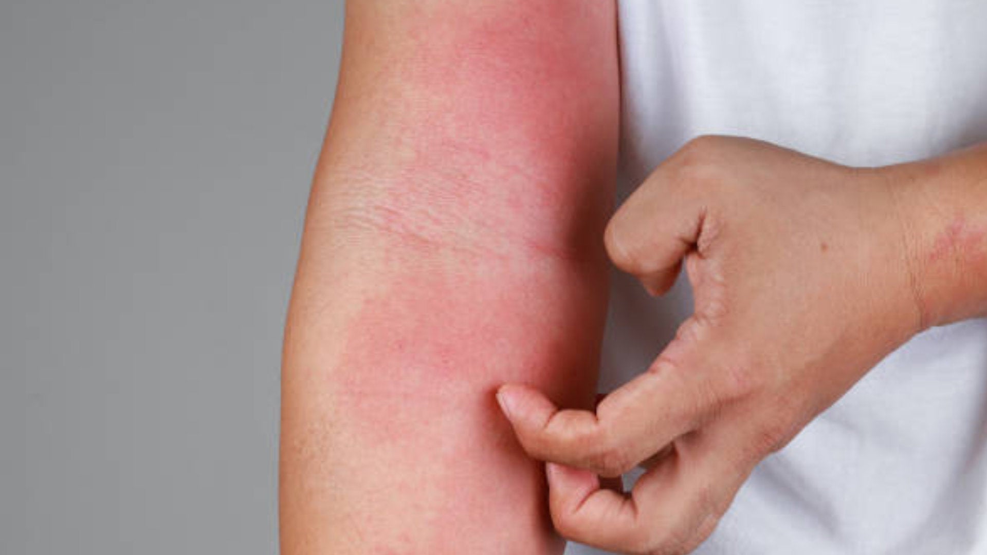 CBD eczema atópico dermatite comichão 