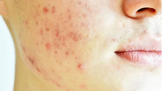 Utilisez les produits Sowé enrichie au CBD pour calmer les irritations provoqués par l'acné