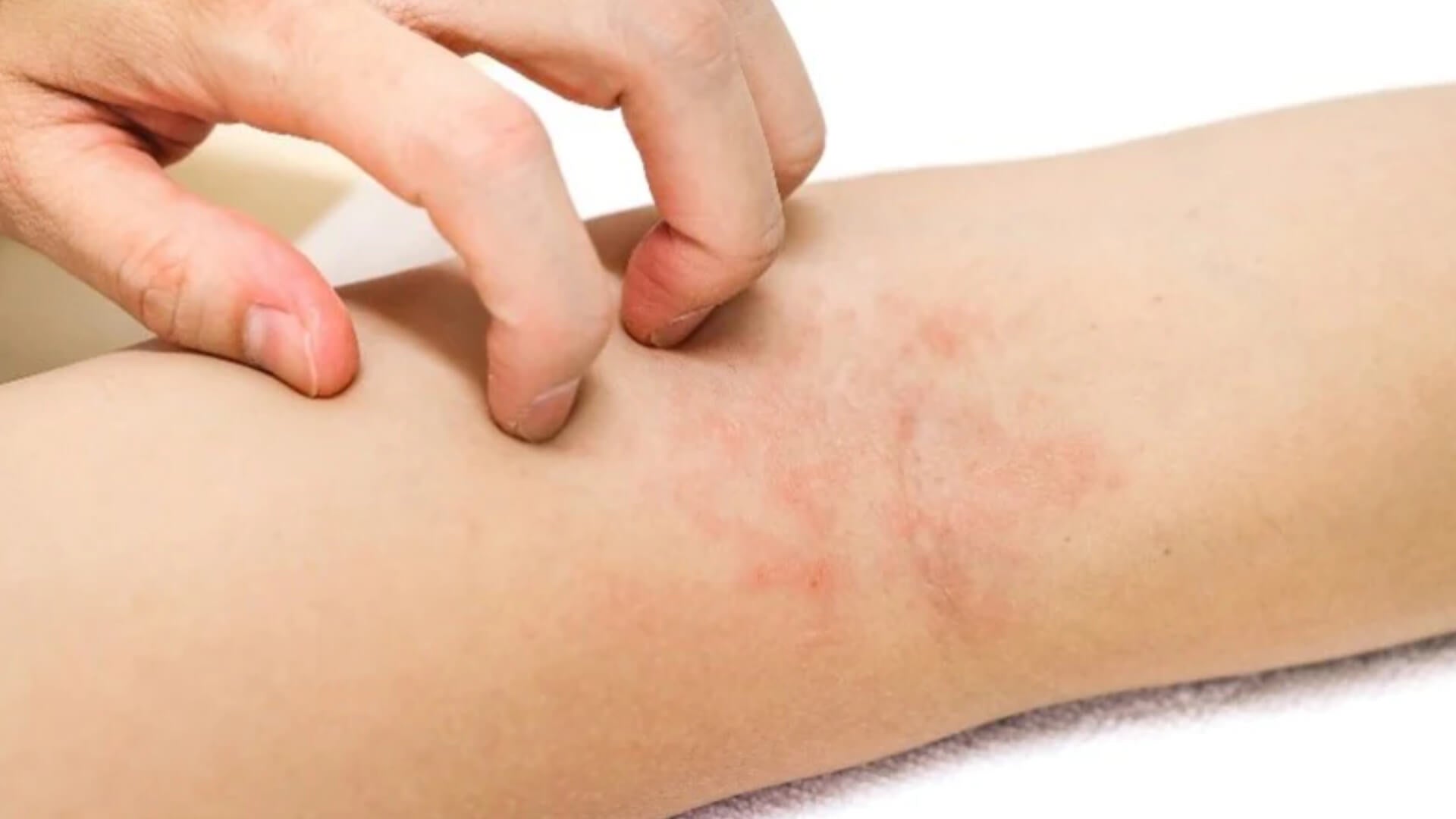 Utilisez L'huile précieuse de Sowé pour soulager les démangeaisons causées par votre eczéma Foto