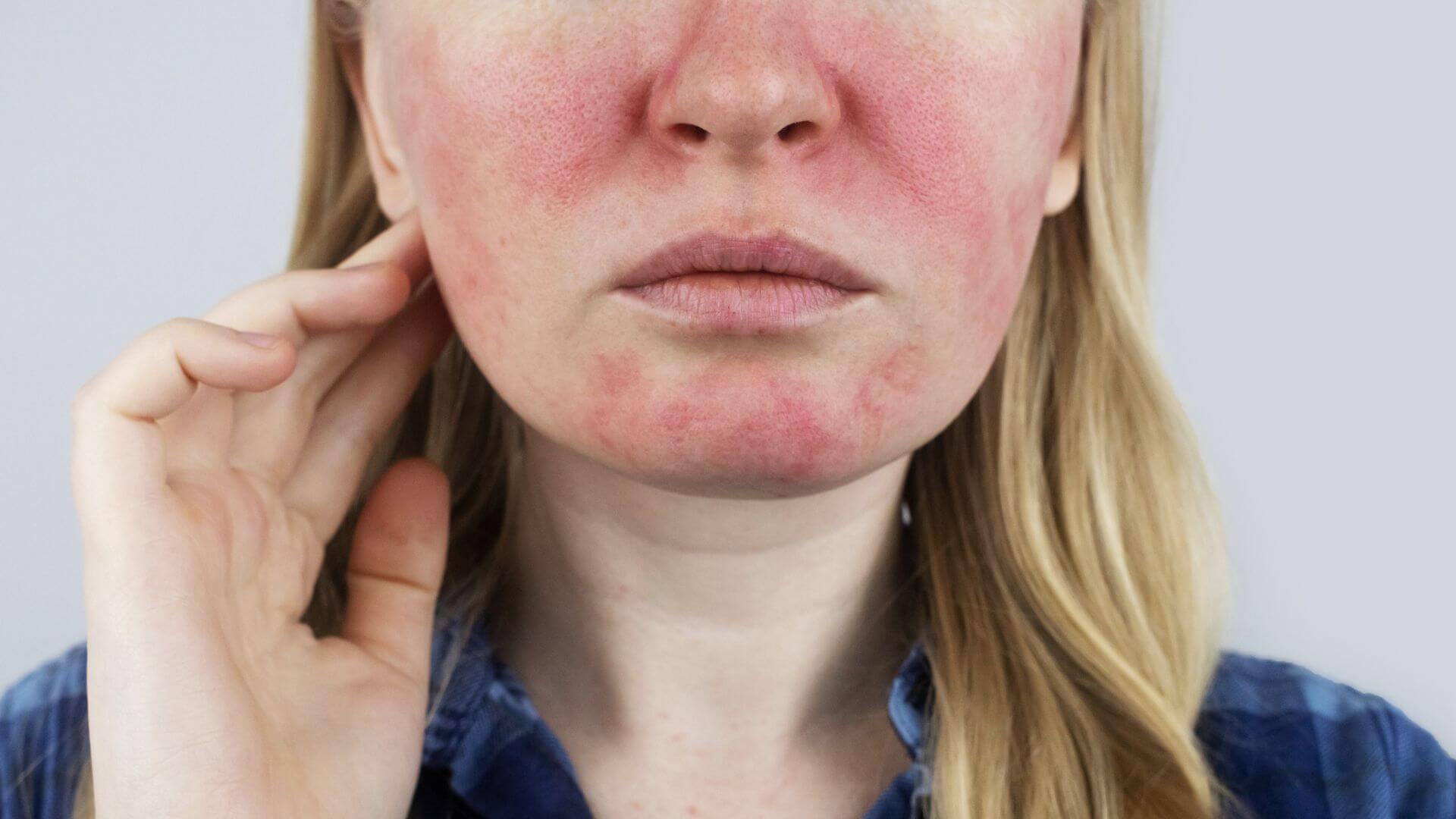 CBD pour rosacée Foto