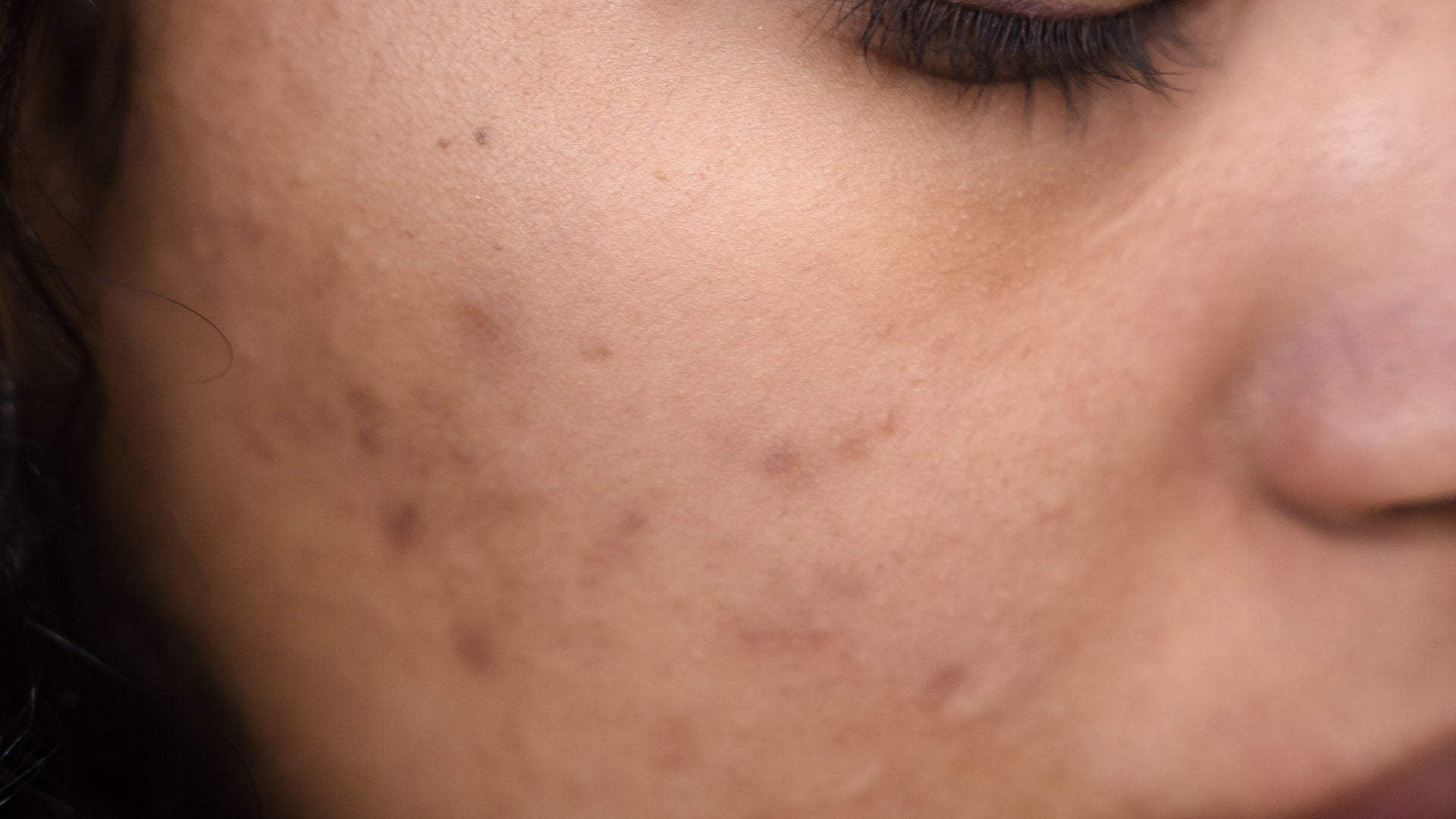 CBD acne inflammation