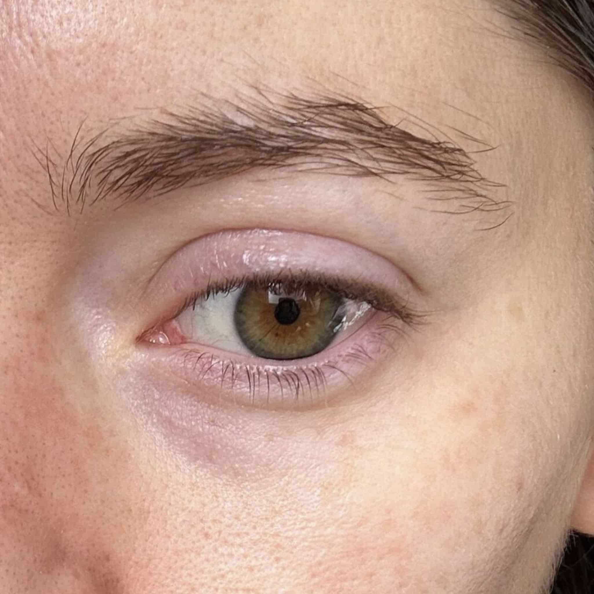 contorno de ojos, ojeras, tratamiento 