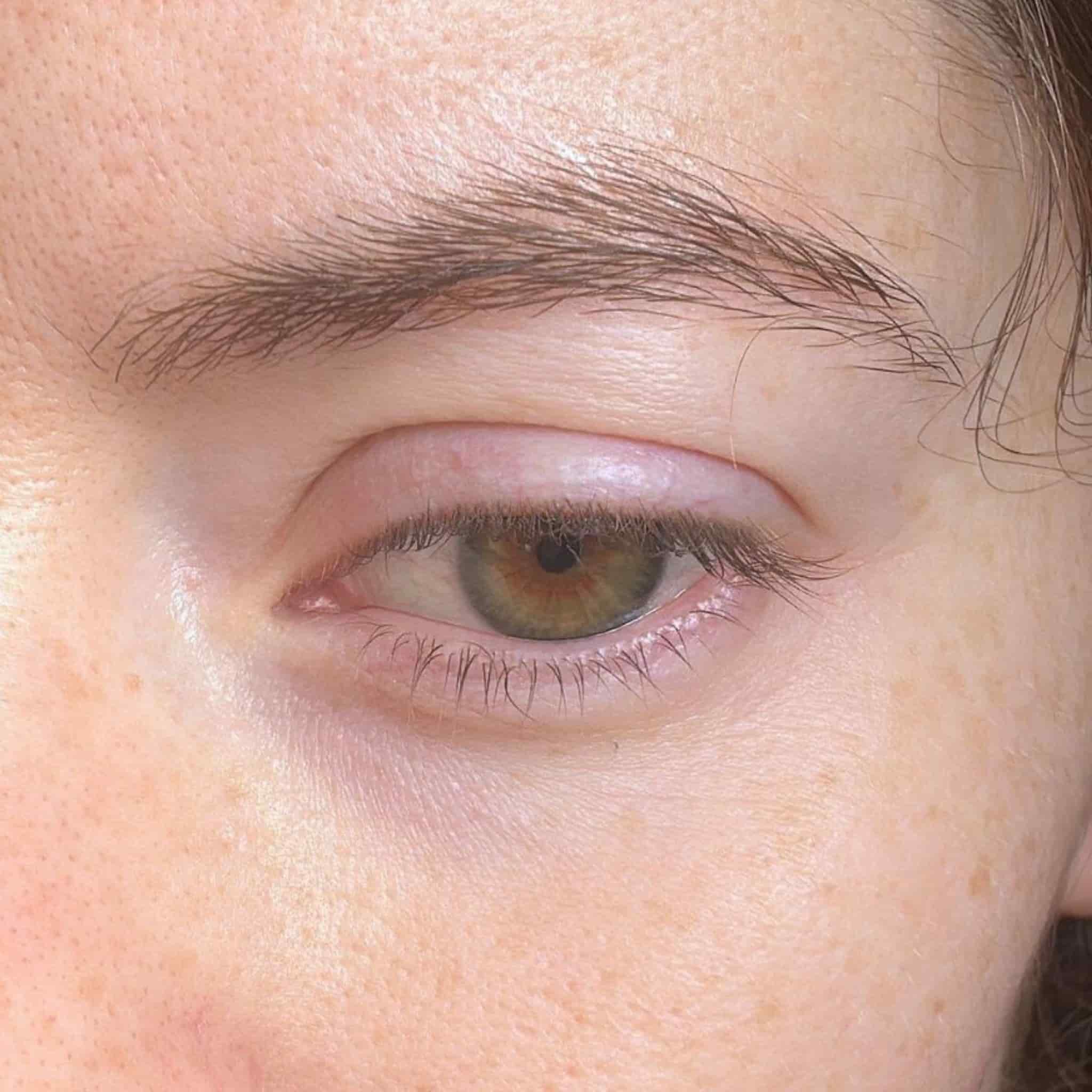 Eye contour anti-spots
