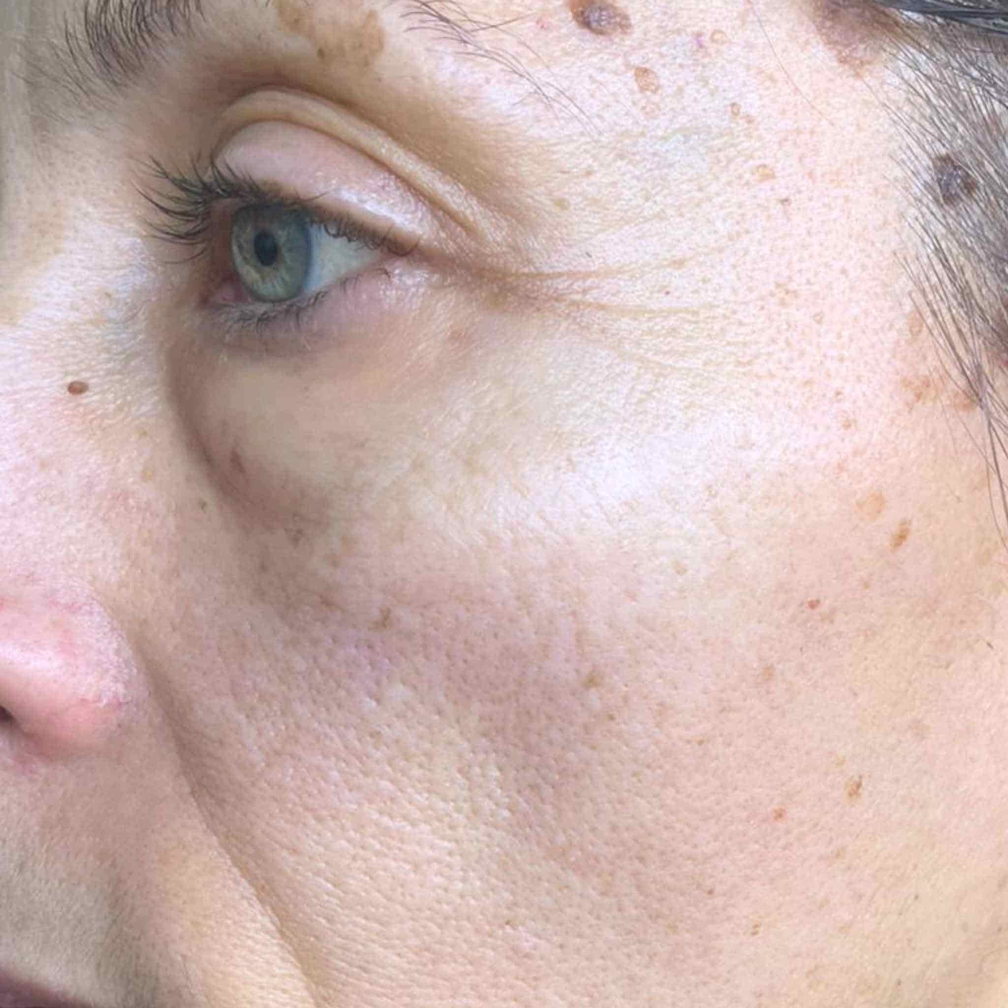 Contour de l eoil aprés application huiel Absolue
